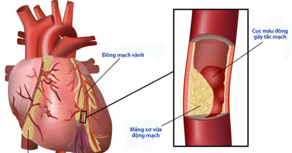 Biến chứng tim mạch